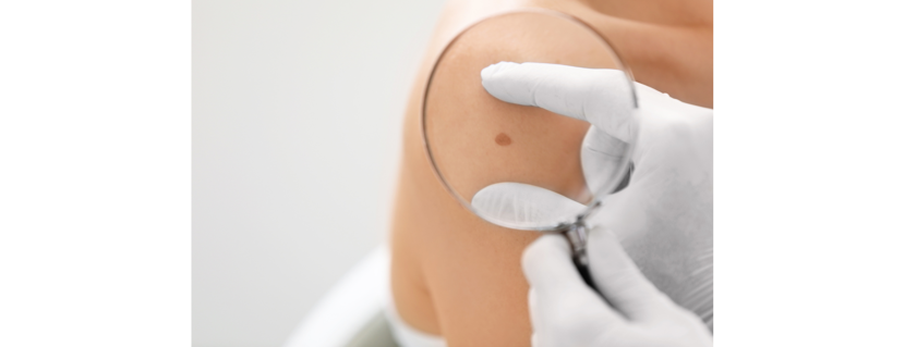 Free SPOT Skin Cancer Screening Program